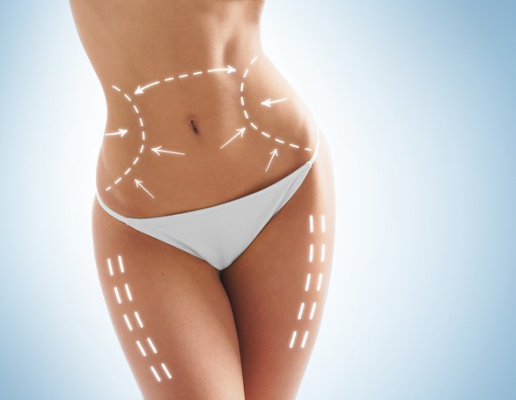 Consta en aspirar la grasa del cuerpo.
