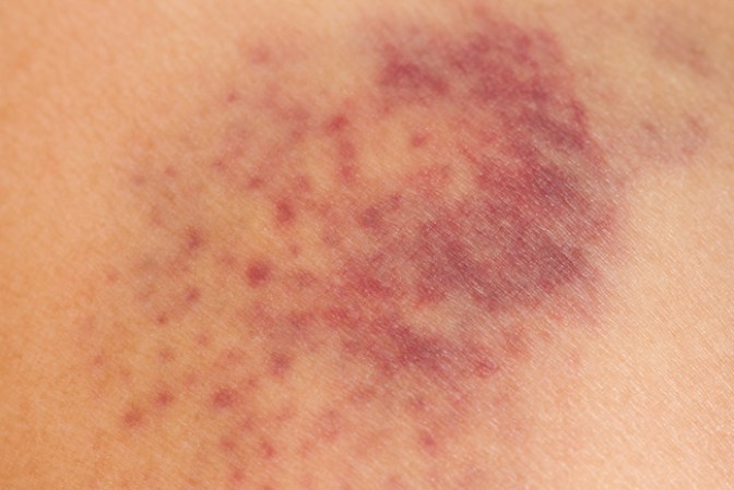 Lo más complicado son lo hematomas que se producen por el sangrado de algunos vasos después de la cirugía.