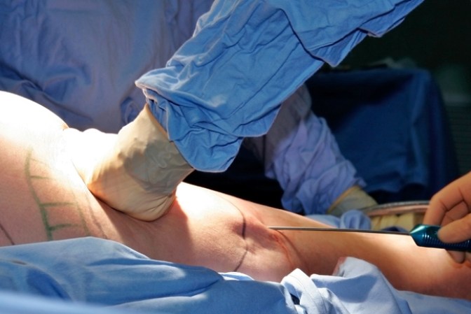 Lipoaspiración