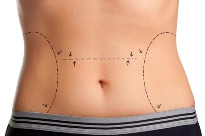 Dermolopectomía abdominal