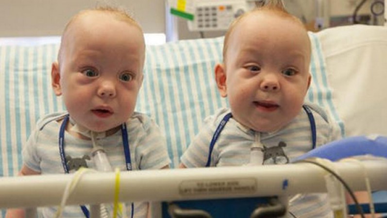 Los siameses que fueron separados en el Medical City Children’s Hospital en Dallas fueron dados de alta.