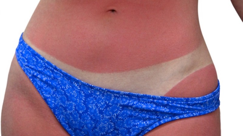 La exposición excesiva al sol puede provocar cáncer en la piel.