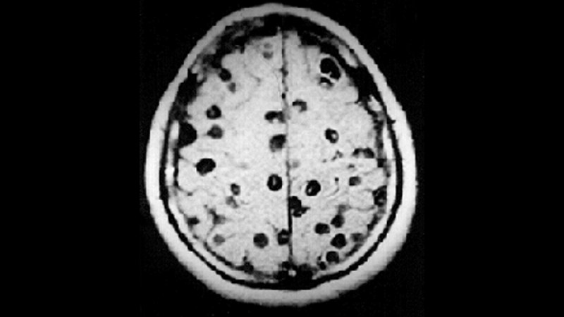 Se llama Neurocisticercosis y cada vez está más presente en el cerebro de muchos hispanos.