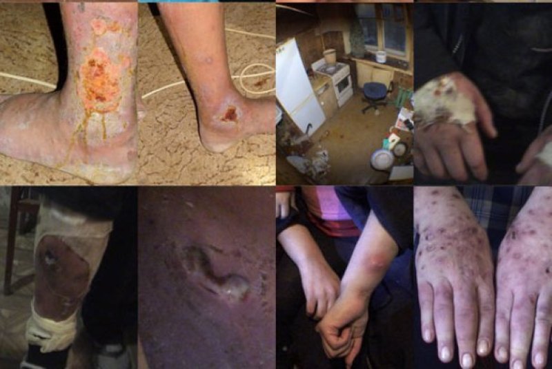 Supuestas víctimas de la droga "krokodil" en Rusia.