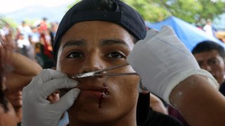 Uno de los migrantes centroamericanos que se cosió la boca en el sur de México este jueves.