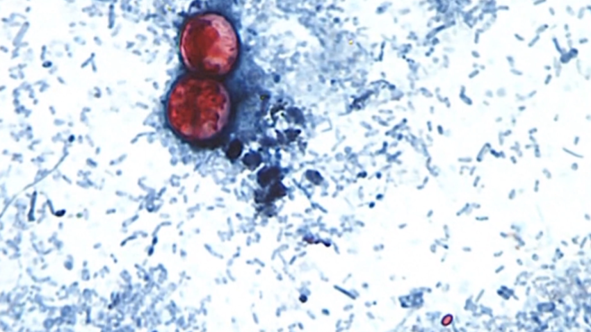 Ciclosporiasis