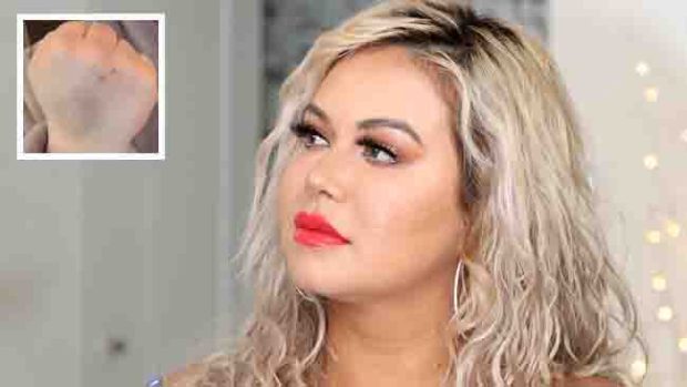 Chiquis explica por qué tiene un moretón en la mano