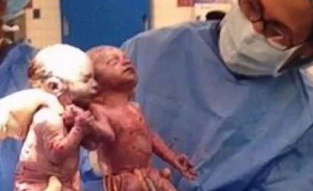 Video: Increíble: Gemelas nacen de la mano