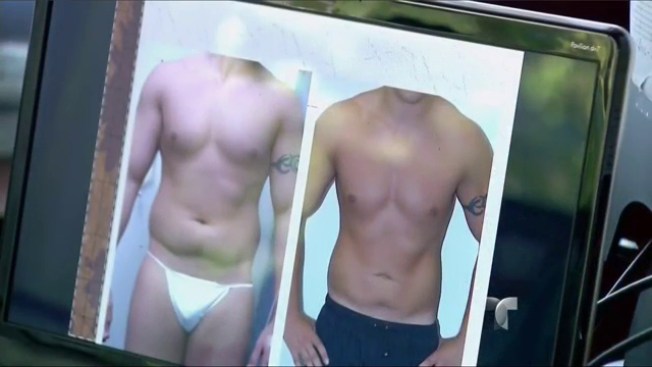 Soldados gordos recurren a liposucción